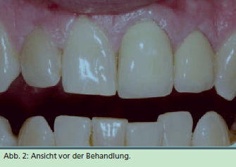 Beispiel einer Zahnfehlstellung Beispiel einer Zahnfehlstellung