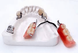 Geschiebeprothese auf mehreren Implantaten Geschiebeprothese auf mehreren Implantaten