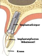 Implantat Komponenten: Implantatkörper und Abutment