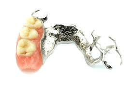 Modellgussprothese Modellgussprothese