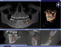 3D Implantologie am Computer