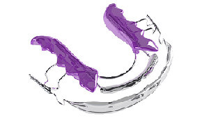Inman Aligner Inman Aligner