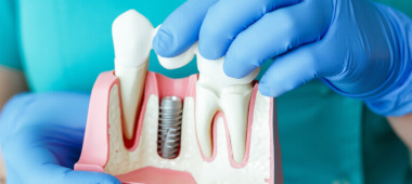 NEU: Mit Keramik ummantelte Zahnimplantate