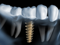 Was kostet ein Implantat